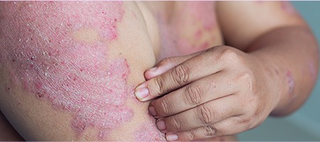 Types of Psoriasis - Plaque Psoriasis